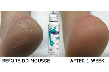 Footlogix - DD-Cream Mousse (125 ml) - Healthcare Shops