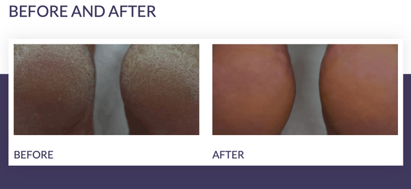 Footlogix - Callus Softener and File - Healthcare Shops
