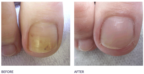 Footlogix - Anti-Fungal Toe Tincture Spray (50 ml) - Healthcare Shops