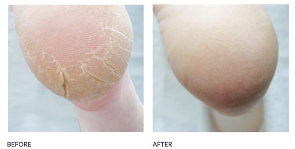 Footlogix - Cracked Heel Formula Mousse (125 ml) - Healthcare Shops