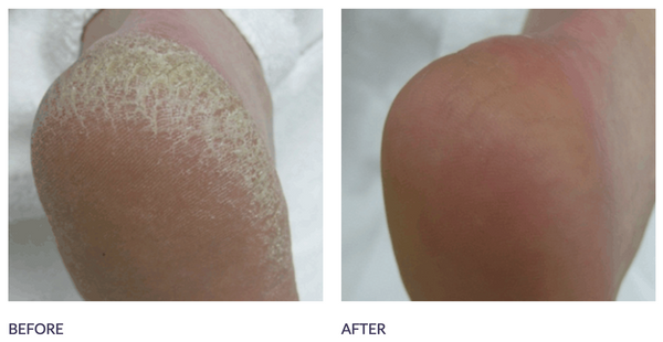 Footlogix - Rough Skin Formula (125 ml) - Healthcare Shops