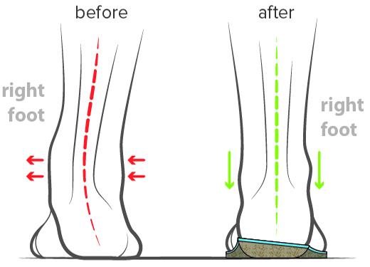 Orthotics Are Often Prescribed For Ankle Instability